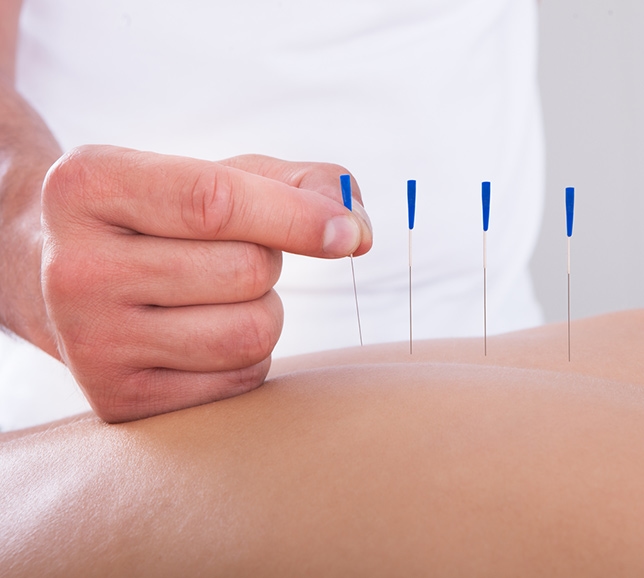 Acupuncture needles being placed on patient's back