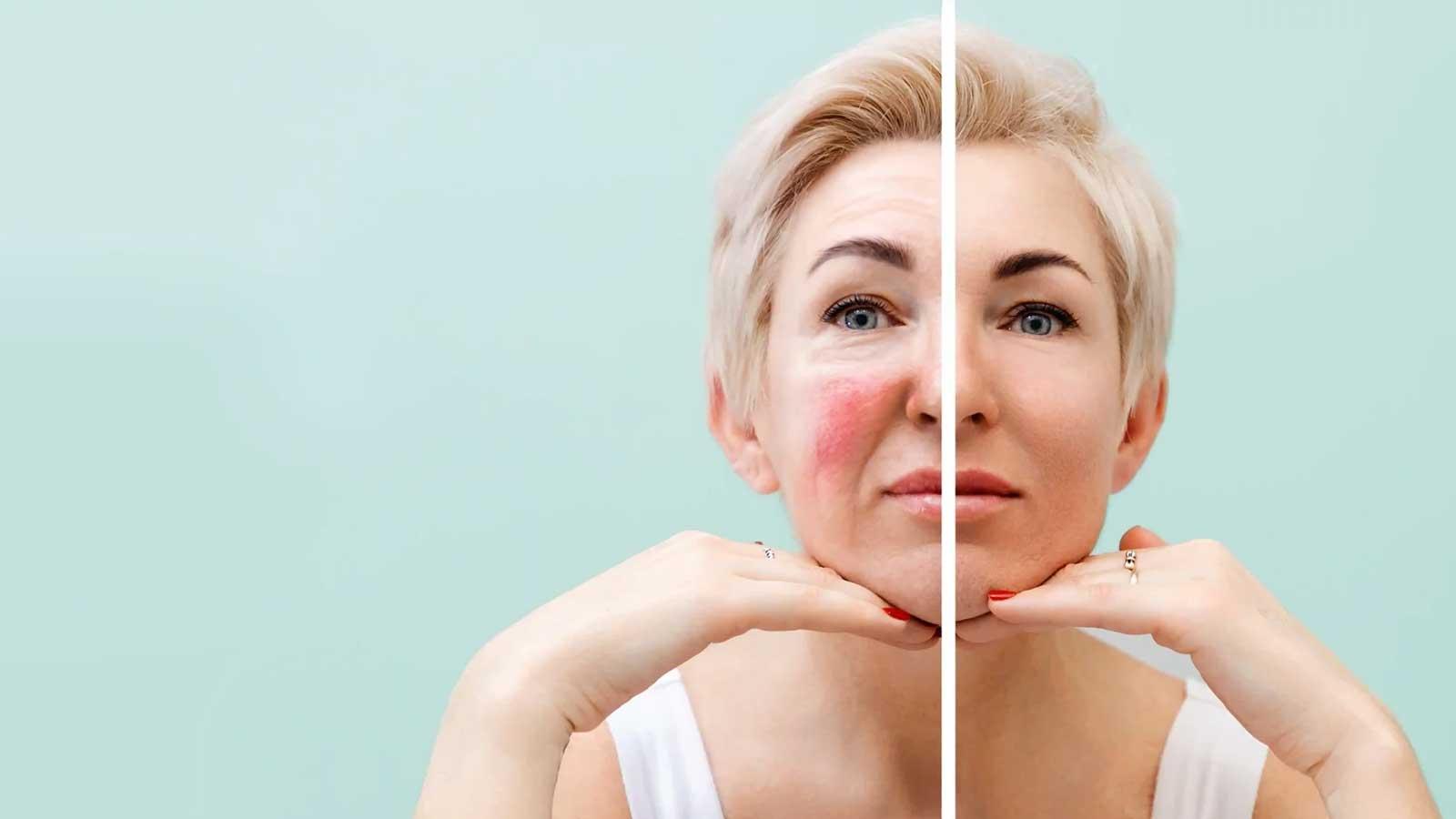 Before and after picture of a lady with rosacea