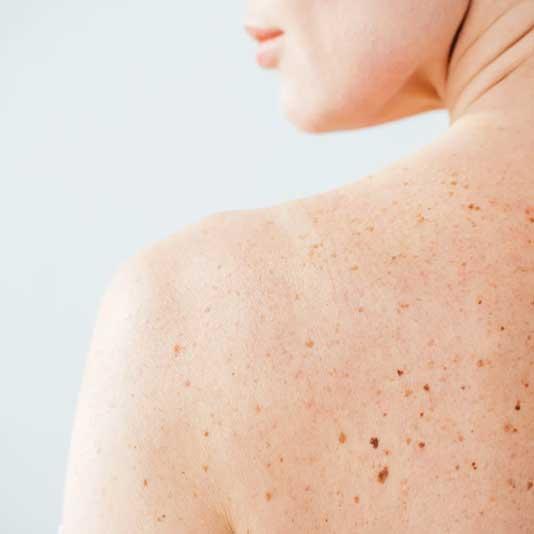 Moles and freckles on woman's back