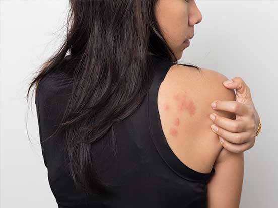 Woman with rash on back